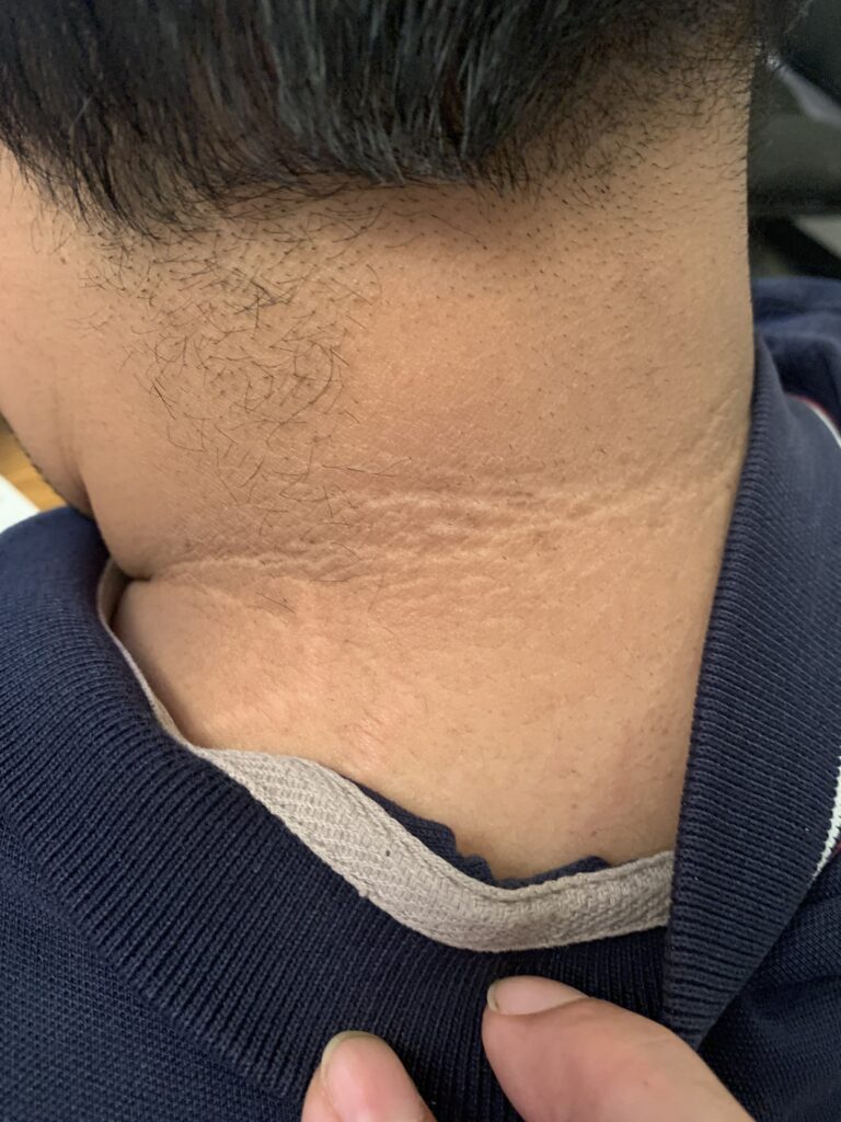 Acanthosis nigricans